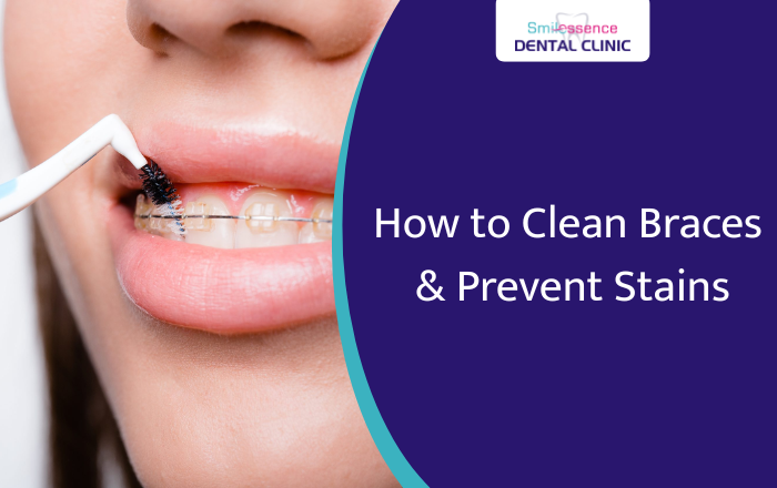 How to Clean Braces and Avoid Tooth Stains: Tips That Actually Work