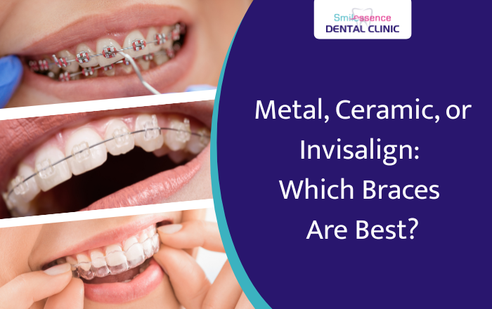 Metal, Ceramic, or Invisalign? Discover the Best Type of Braces for You