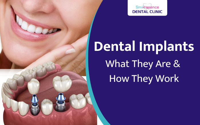 What Are Dental Implants and How Do They Work?